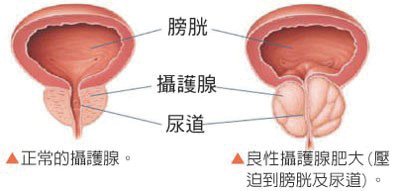 內視鏡雷射攝護腺汽化手術02良性攝護腺增生症俗稱攝護腺肥大是許多老年男性常見的疾病